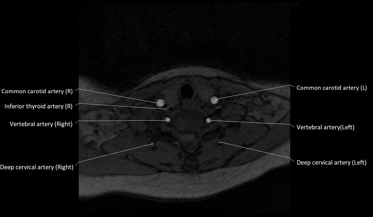 Carotid artery anatomy axial 3T image 54.jpg